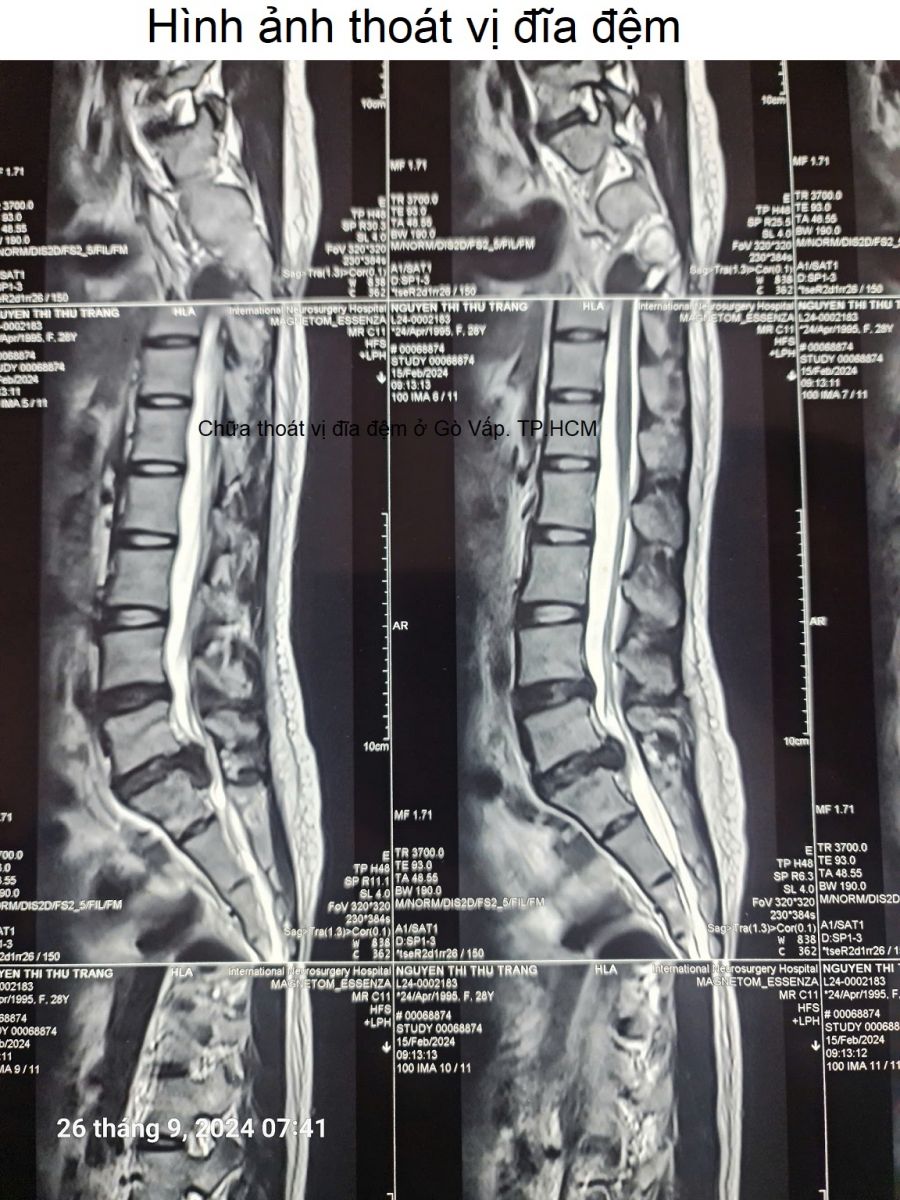 Hình ảnh thoát vị đĩa đệm